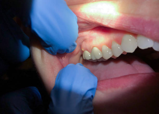 Best Emergency Treatment for Toothache in Cottonwood, CA